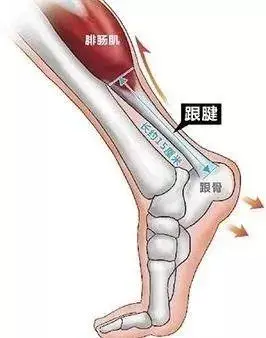 在运动过程中,小腿腓肠肌和跟腱承受了反复过度牵张力导致的.