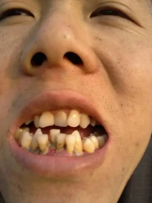 下门牙中间那颗十分松动!该怎么办!