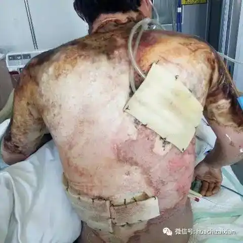 华池县上里塬文永永,意外触电,生命垂危,恳请大家伸出援助之手帮帮他!