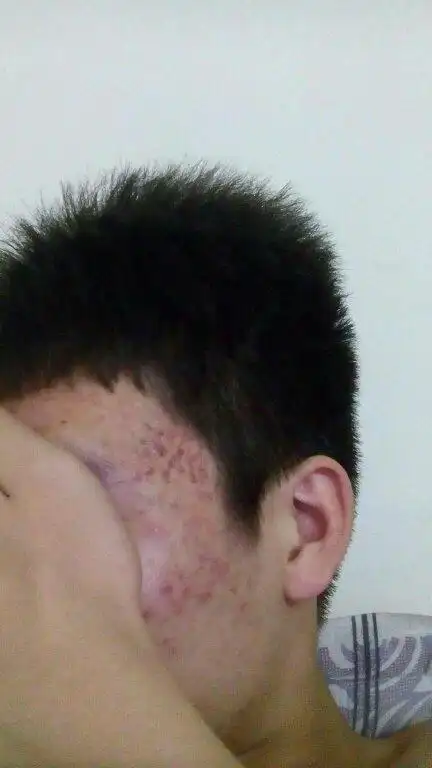 痘痘,又好像不是痘痘,一种黑色素,我每天晚上11点