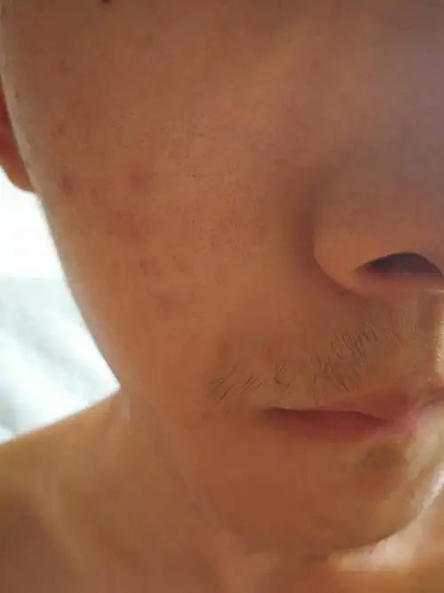 男生20岁,脸上皮肤很差,貌似集合重缺点,好歹不黑看着还凑合,,,,,求