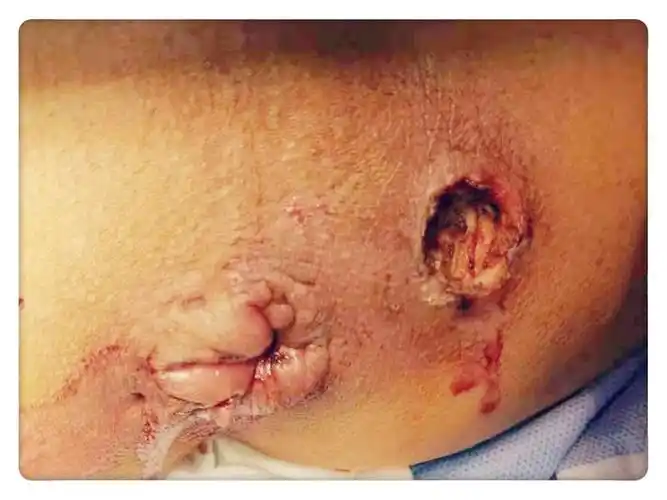 渭南市第二医院普外科率先完成首例高位经括约肌肛瘘(lift)术