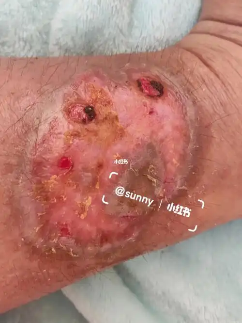 烫伤恢复第88天