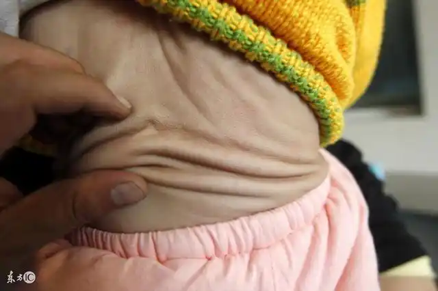 生完孩子之后,肚子就像泄了气的气球,皮肤变的松弛