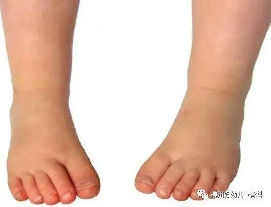 孩子走路"内八字"怎么办? - 好大夫在线