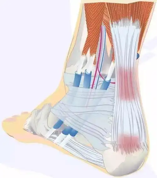 跟腱是人体最粗壮的肌腱,是腓肠肌和比目鱼肌的连体肌.