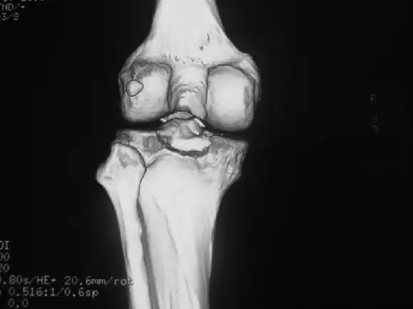 关节镜下治疗一例胫骨髁间嵴撕脱骨折