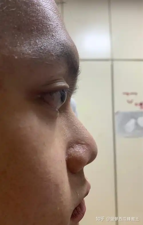 眼球突出 - 知乎