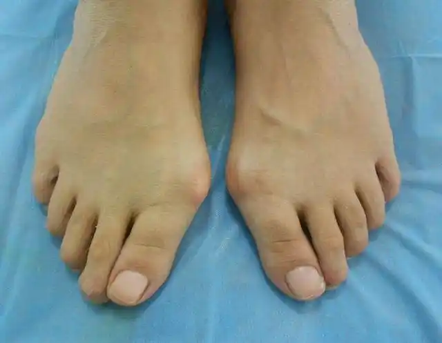 经常穿高跟鞋脚趾会变形,是真的吗?医生:脚趾外翻不容小觑