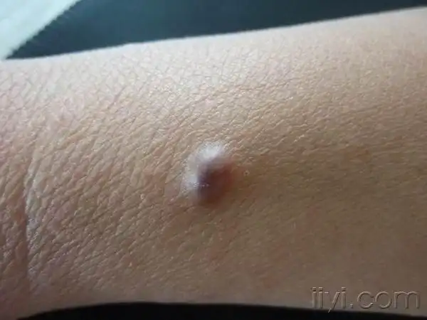 前臂蚕豆大丘疹,伴疼痛(答案:良性纤维组织细胞瘤 - 皮肤及性传播疾病