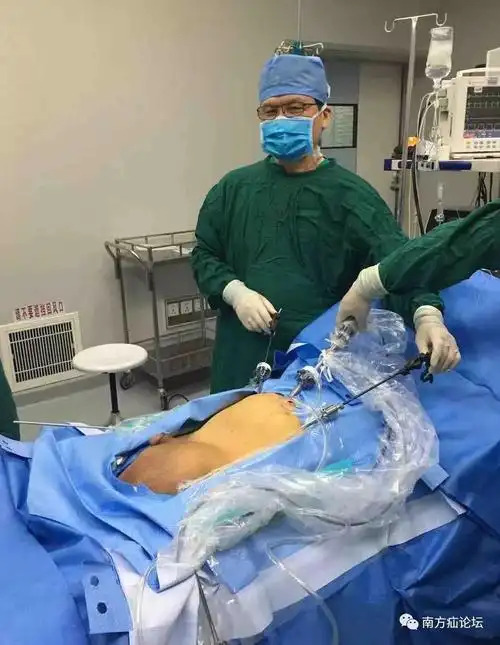 讨论巨大腹股沟阴囊疝4