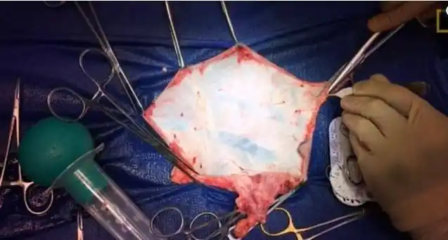 美国男子的变性手术术后欣喜非常摄影师拍下全程