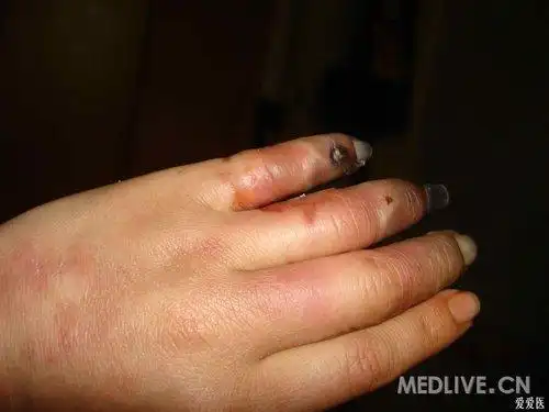 hs病例分析手指头坏疽