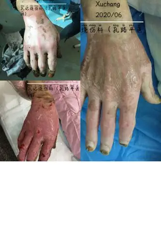 全身大面积铁水深度烧伤中医药湿润疗法