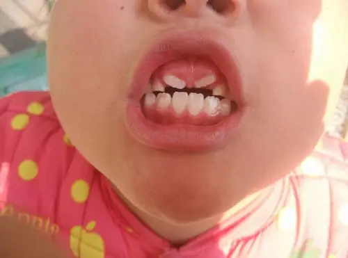 看看我家孩子的牙该怎么办?谢谢