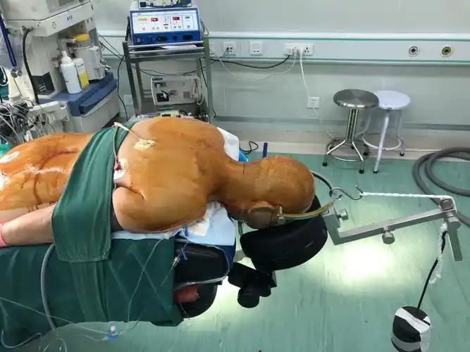 术前颅骨牵引,骨折复位