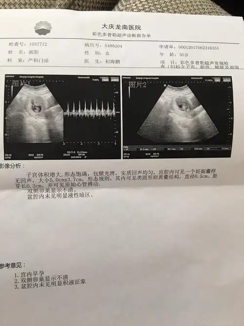 有的受孕早的准妈妈或许还可以看到胎芽二孕囊和胎儿大小对照表 15