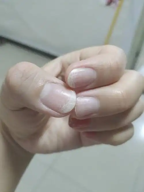 手指甲最近总分层,撕裂是怎么回事,麻烦懂的人帮我解答一下,万分感谢