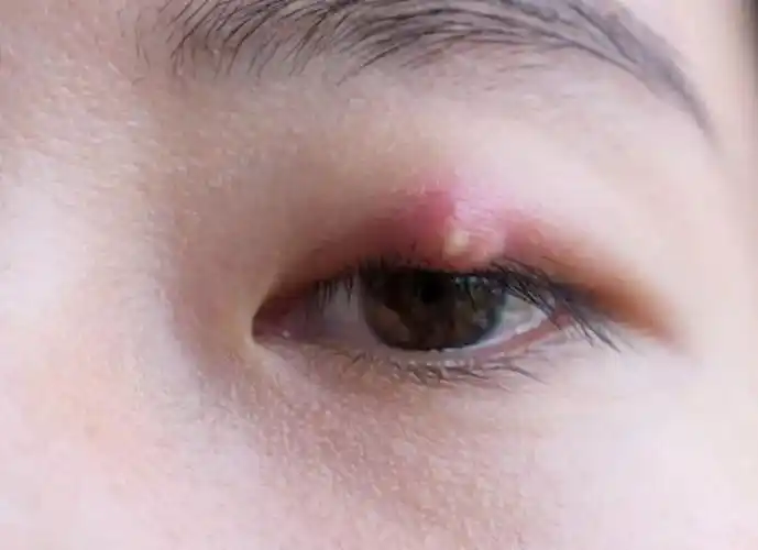 长了"针眼"(麦粒肿),怎样才能消的快?眼科专家来支招