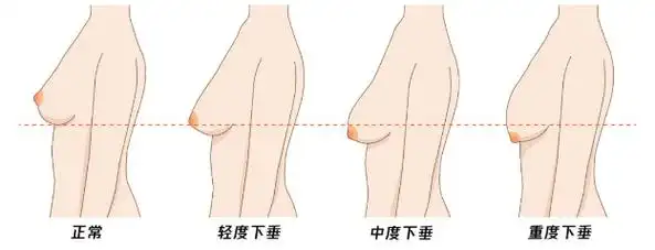 1~2cm 属于轻度下垂;乳房下垂的妇女,双侧乳房大小基本正常但皮