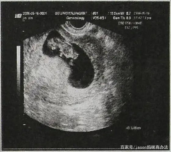 0-4周:胚前期;5-10周:胚胎期;11-40周胎儿期 30—40天形成的是胎囊