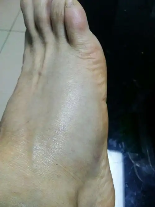 崴脚了――第一次脚肿这么厉害!