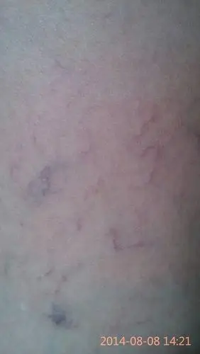 妈妈腿上有好多小血丝,也不疼也不痒的,有谁知道是怎么回事呢?