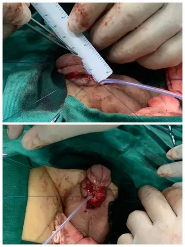 张家界市人民医院再次独立完成一例高难度尿道修复手术