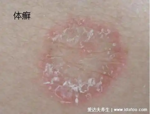 18种常见的皮肤病图片对照表,湿疹/荨麻疹/扁平疣/毛囊炎合集