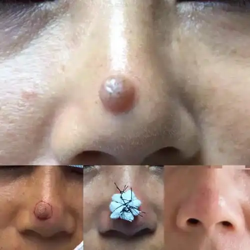 切痣怎么缝合? - 好大夫在线