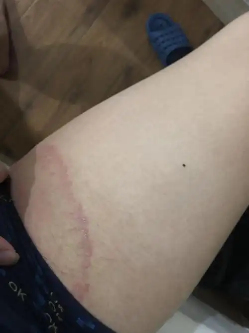 男,大腿两侧内侧有红斑,很痒