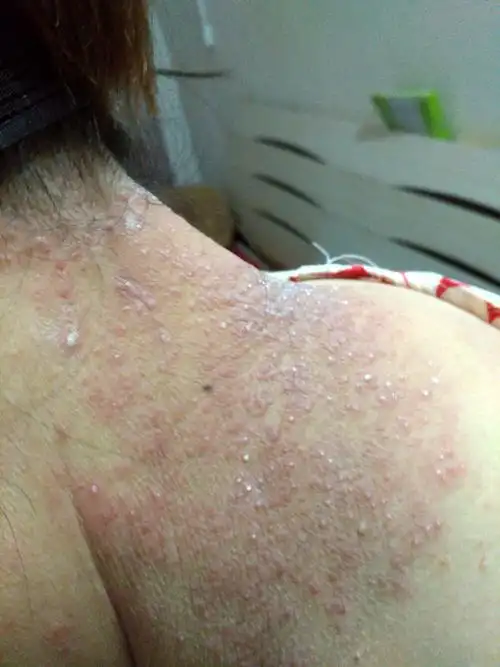 脖子前突然长了小疙瘩特别瘙痒(脖子前突然长了小疙瘩特别瘙痒怎么