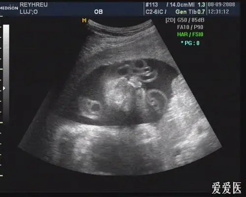 双侧唇裂 ,腭裂, 二维图片 三维图片