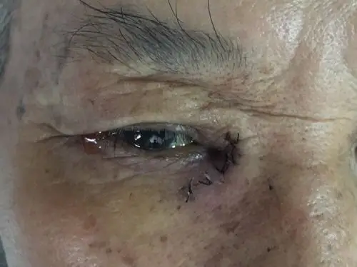 传统手术(外路),皮肤可见切口,术后留有疤痕