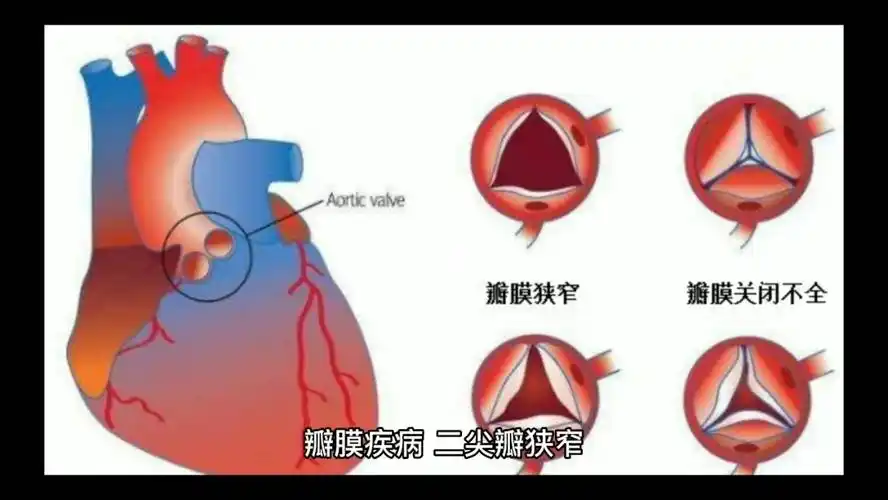 二尖瓣面容杂音:心尖部可闻及舒张期隆隆样杂音二尖瓣关闭不全杂音