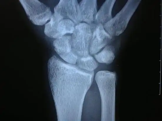 舟骨坏死怎么办 舟骨坏死的几率有多大