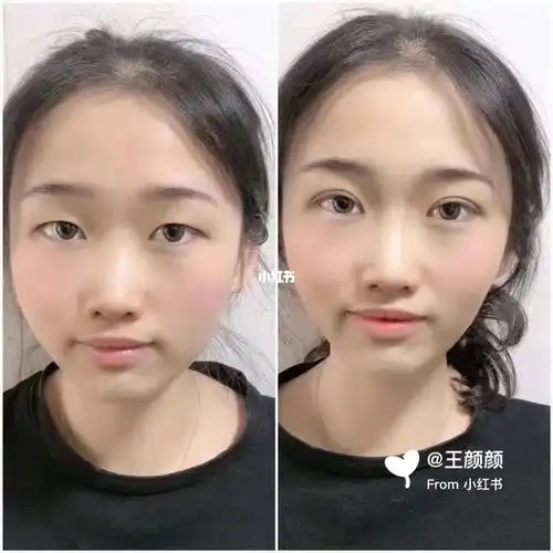 双眼皮前后对比