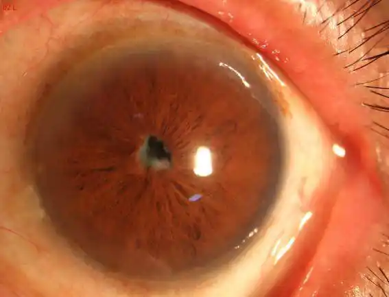 七旬大娘双眼瞳孔"消失"近40年!