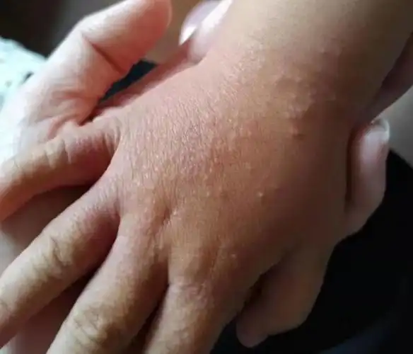 以面部丘疹为例,讨论小儿丘疹性疾病的鉴别