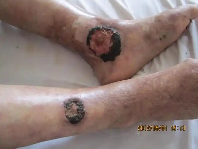 请问有谁看过这种皮肤病有点恶心