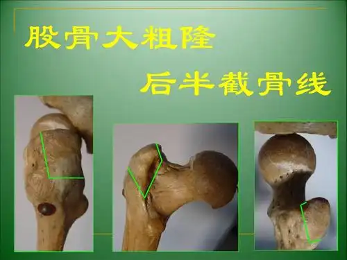 股骨大粗隆 后半截骨线