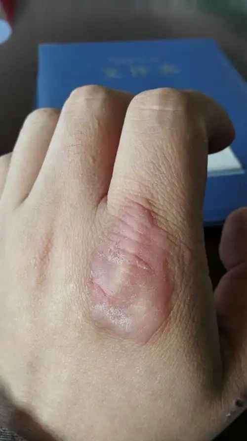 左手食指与手掌连接关节皮肤上长了一块像茧子一样的癣,应该怎么治疗?