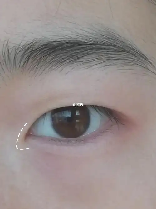 上回有姐妹问同样的眼睛 内眦赘皮特重,我平时都是怎么开眼角的,那
