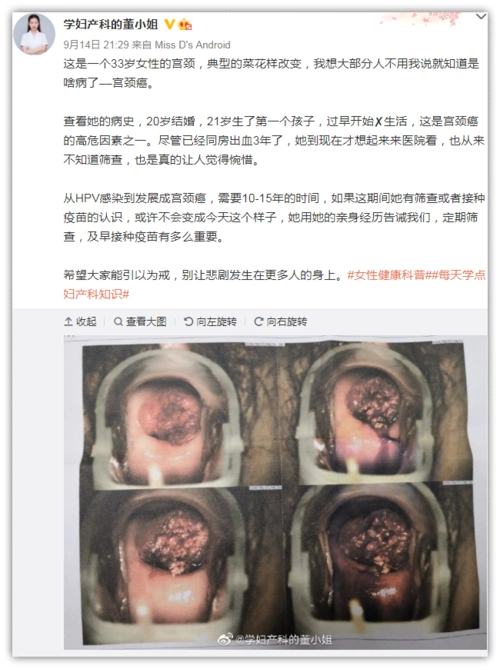 让人头皮发麻的宫颈宫颈癌更易找上这6种人