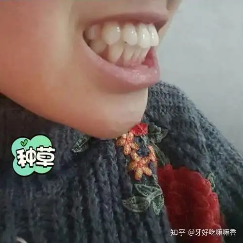 龅牙会遗传吗龅牙有哪些危害