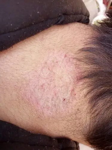 朋友脖子上的东西是什么?除了痒还蔓延到前面了,已经有一个多月时间了