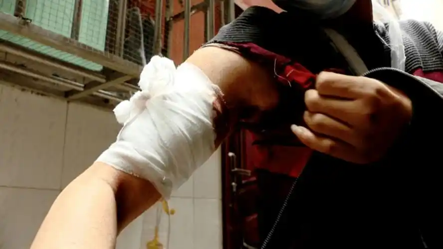 拒借1000元,南宁一外卖员被砍伤手臂,缝了8针!手机都被劈裂了._蒙某