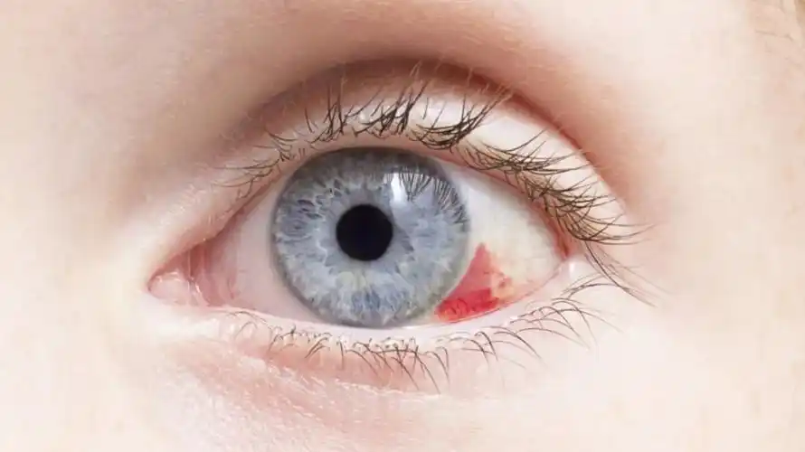 很多患者眼睛出血,眼白部分看起来一片鲜红,这种情况大多数就是眼表