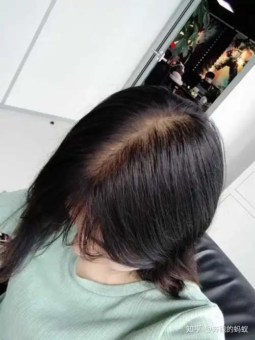 女生头顶头发少是什么体验 ?