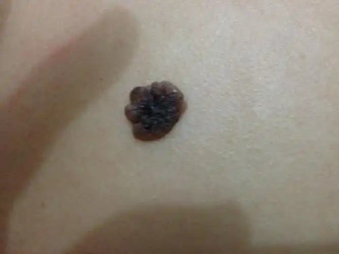 请问身上有这样一个痣能去掉吗?